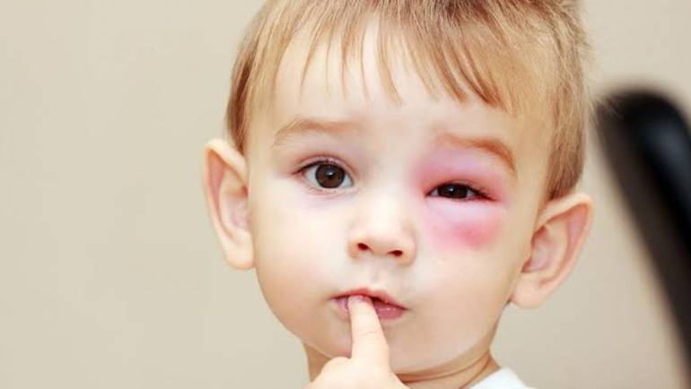 Traumas oculares na infância: O que são? Como evitá-los?