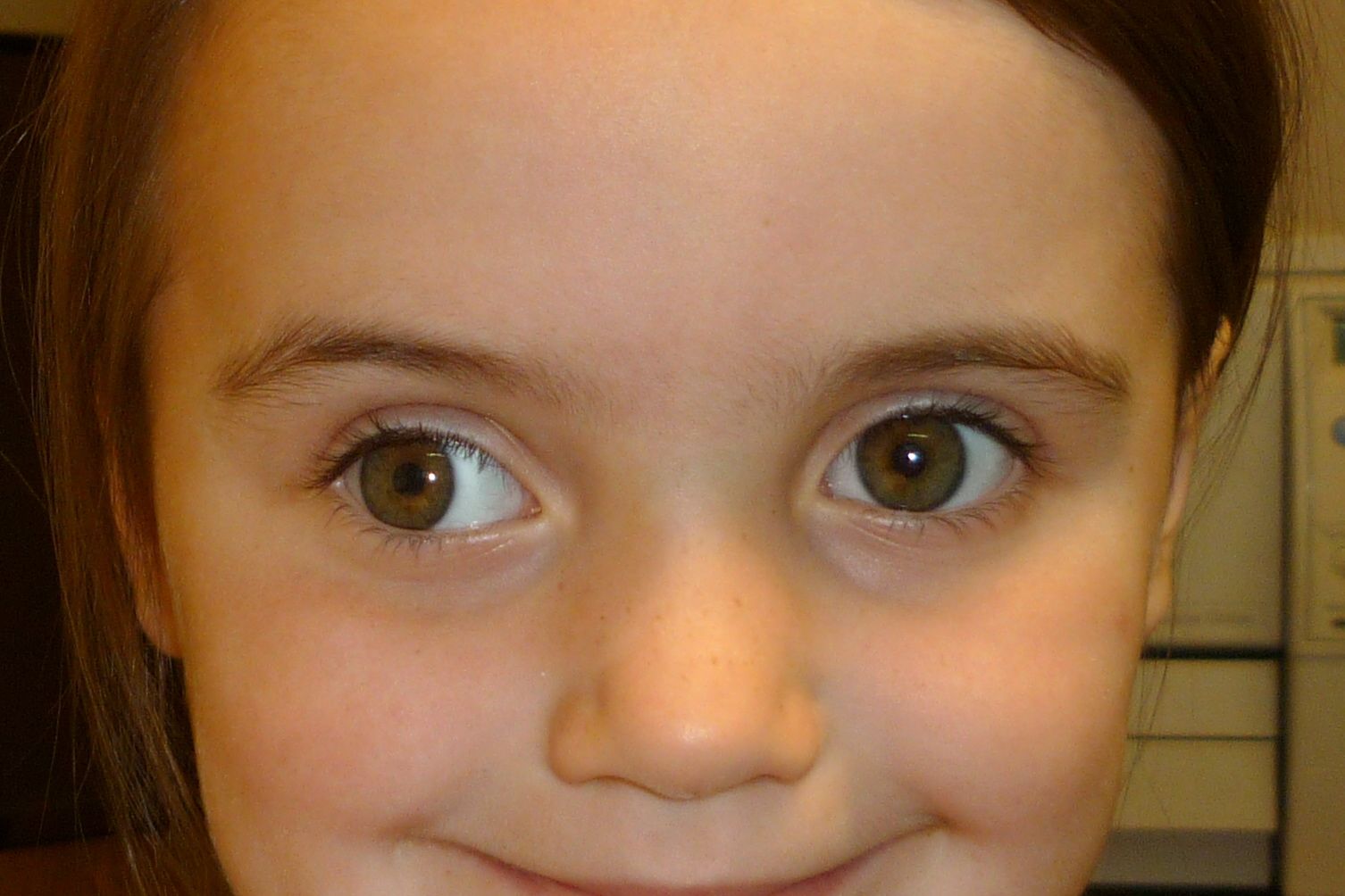 Ребенок косит глазки. Амблиопия (синдром ленивого глаза). Косоглазие экзотропия. Расходяшие косрюоглазия. Косоглазие у детей.
