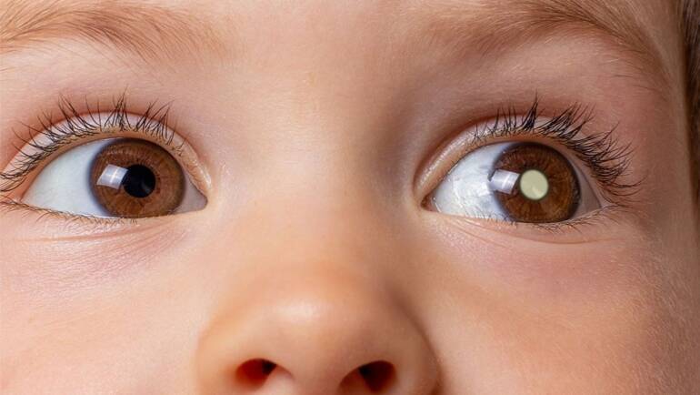 Retinoblastoma é câncer ocular mais comum na infância