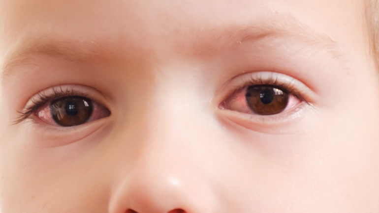 Sinais e sintomas da conjuntivite viral em crianças
