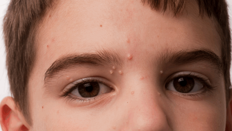 Molusco contagioso ocular em crianças exige atenção