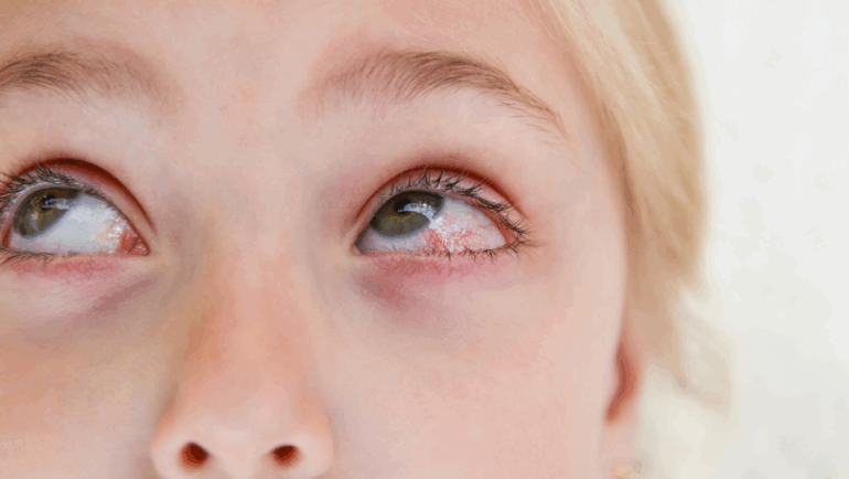 Sintomas da conjuntivite alérgica – Como reconhecê-los